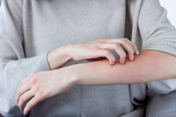 Homeopathy for skin disorders — acne, eczema, psoriasis and pigmentation